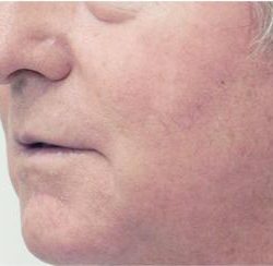 Excel V - Cutera Before & After Patient #1662